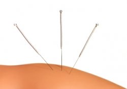 Boulder acupuncture relieves back pain and neck pain